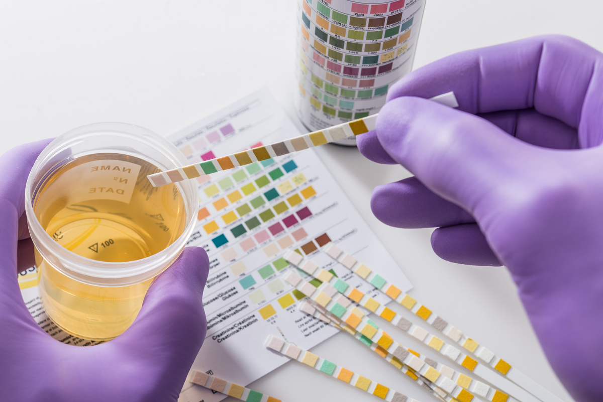 Badanie moczu przy użyciu paska diagnostycznego. Źródło: Getty Images Badanie moczu